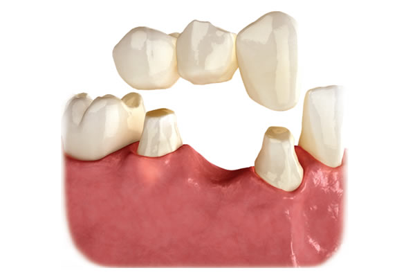 Dental Bridge where healthy teeth are ground down. Tooth preparation for Bridges may lead to more cavities and failure of the supporting teeth