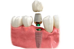 Sinble Dental Implant
