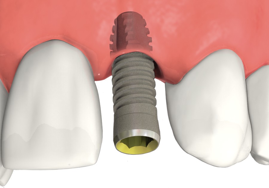 The implant is placed in the bone beneath the gum