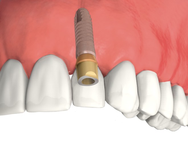 Dental Implant Abutment and final crown are custom made to match your existing teeth