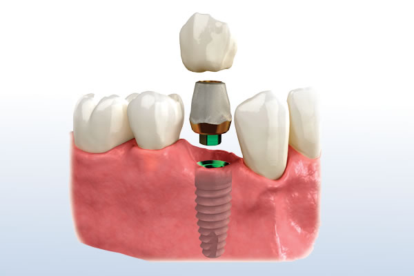 Dental Implants