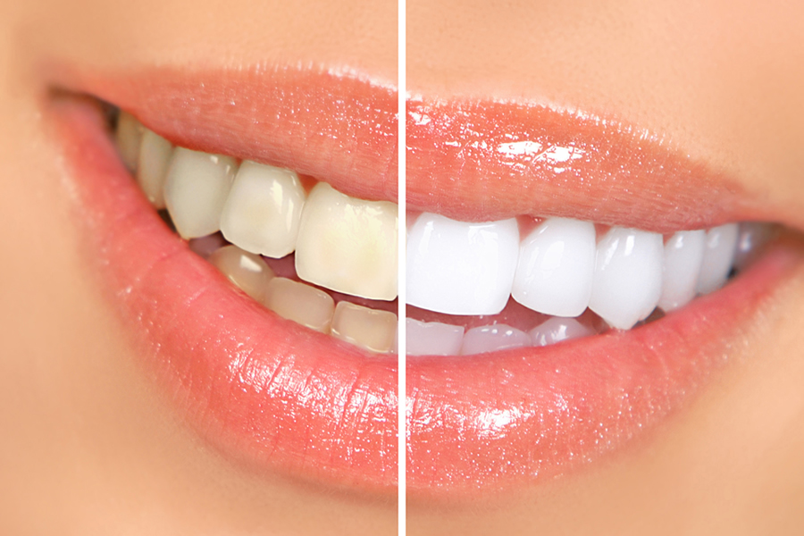 Teeth Whitening