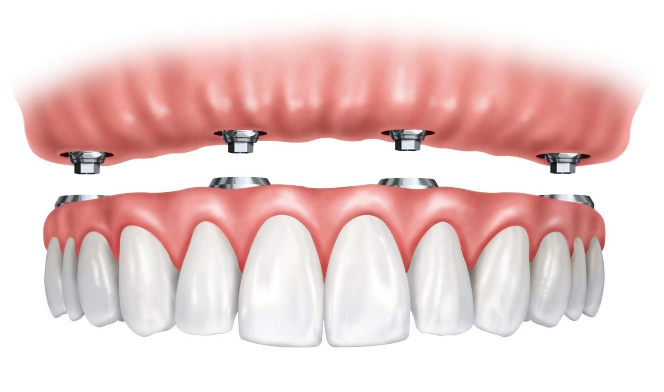 Same Day Implant Teeth