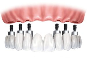 Dental Implant Bridges