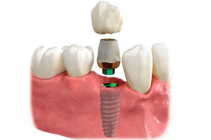 Dental Implants