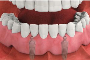 Dental Implant Dentures