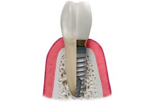 What are dental implants?