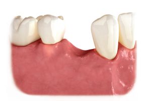 Missing teeth create gaps in your smile and reduce your chewing ability.