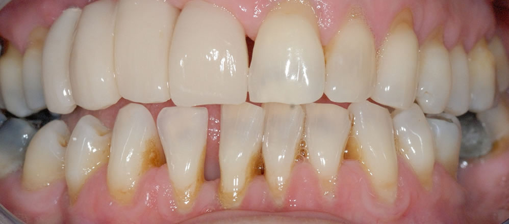 After Dental Implant Bridge Treatment